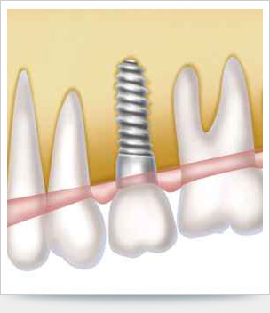 Immagine di un impianto dentale