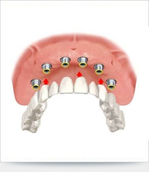 Immagine di un impianto dentale
